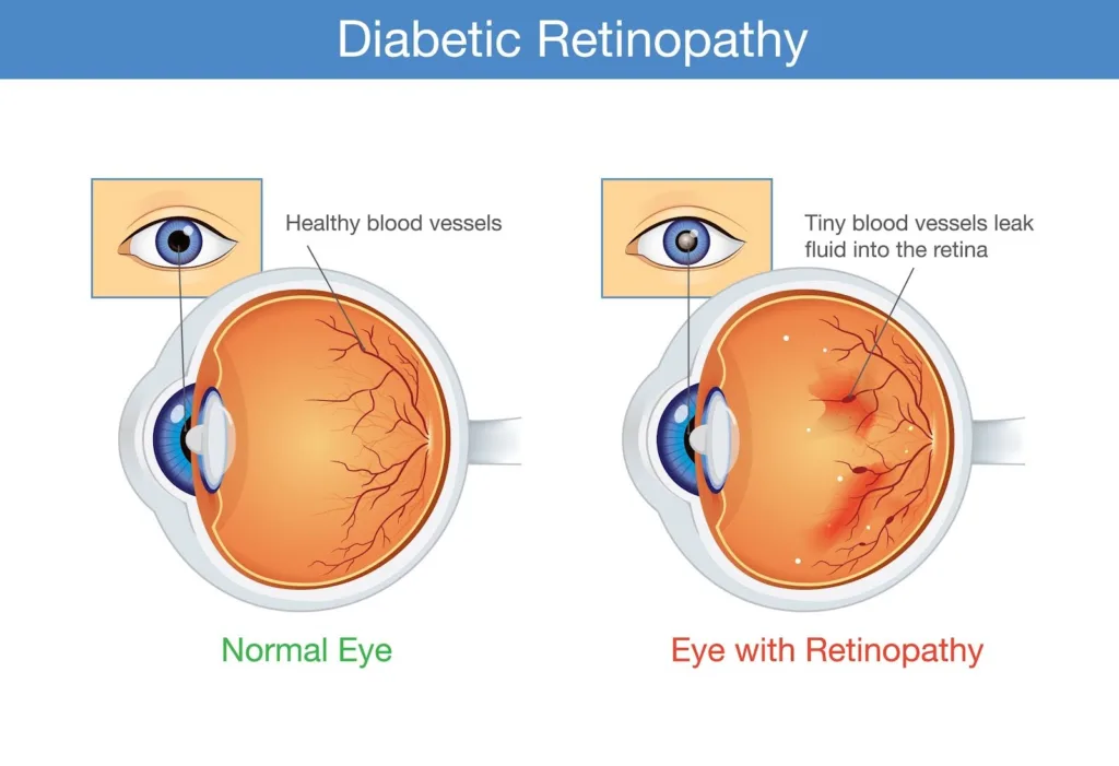 illustration of diabetic retinopathy for am I diabetic signs
